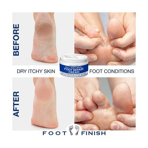 How To Heal Dry, Cracked Heels Quickly With Home Remedies, 55% OFF