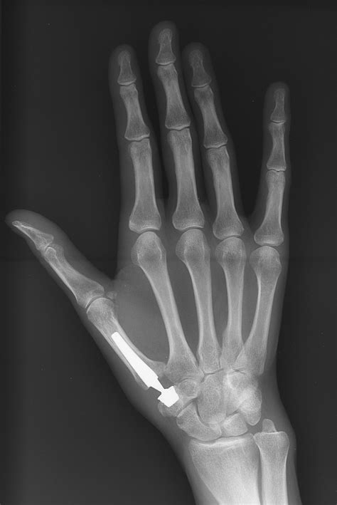 Arthritis Joint Replacement Thumb at Mark Cox blog