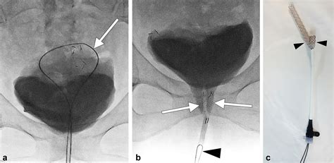 Technical Notes on Fluoroscopy-Guided Removal of Metallic Ureteral Stents - Journal of Vascular ...