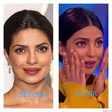 Priyanka Chopra Face Surgery