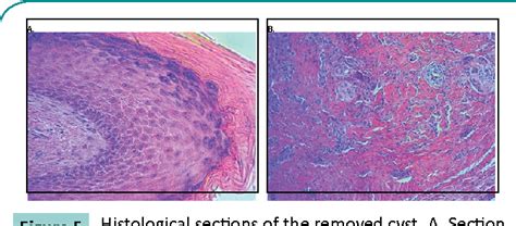 Image result for Elbow Cysts Explode