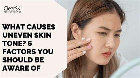 What Causes Uneven Skin Tone? 6 Factors You Should Be Aware Of - ClearSK Aesthetic Clinics