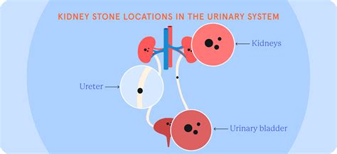 Stones To Solutions: A Kidney Stones Guide | Fluent Health