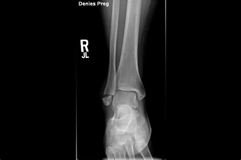 Ortho Dx: Can You Diagnose the Weber Fracture? - Clinical Advisor