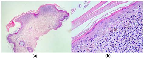 Widespread and Long-Enduring Hyperkeratosis Lenticularis Perstans ...