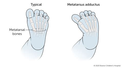 Metatarsus Adductus | Boston Children's Hospital