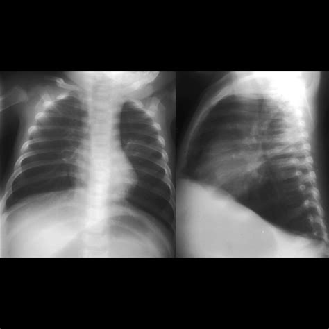 Respiratory Syncytial Virus Pneumonia | Pediatric Radiology Reference Article | Pediatric ...