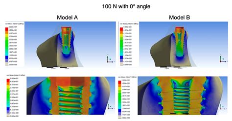 Finite Element Analysis of a New Dental Implant Design Optimized for the Desirable Stress ...