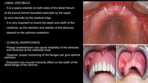 ANATOMICAL LANDMARKS OF MAXILLA AND MANDIBLE.pptx