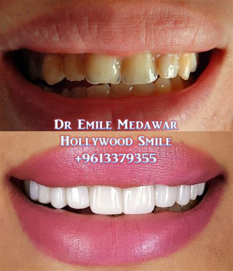Direct Veneers by Dr Emile Medawar | Emax Veneers Lebanon