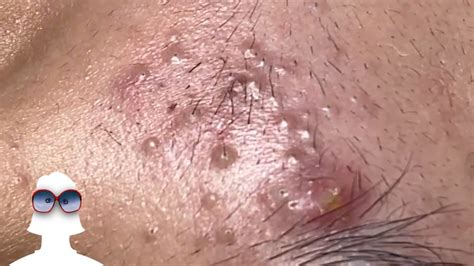 Exploding Pimples 2018 的图像结果
