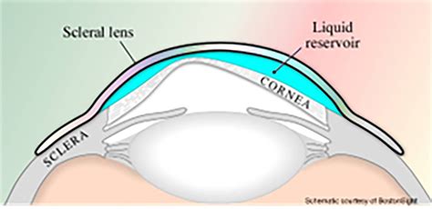 Scleral Lens Eye Drops at Patrick Lauzon blog