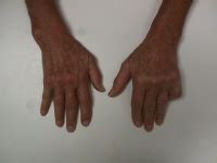 Image result for Hand Dysfunction