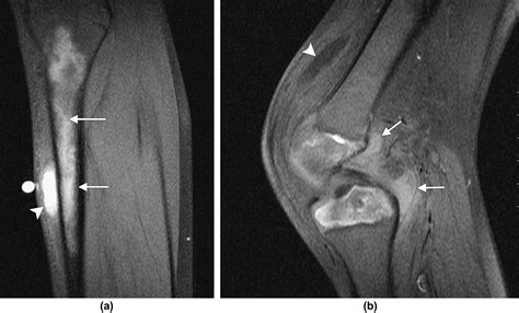 Acute bone crises in sickle cell disease: the T1 fat-saturated sequence in differentiation of ...
