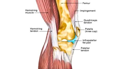 What is Hoffa's fat pad edema? - ANF Academy