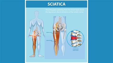 साइटिका और कमर के दर्द में अंतर | Difference Between Sciatica and Back ...