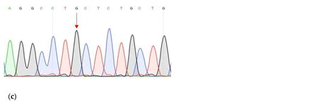 Whole Exome Sequencing Study Suggests an Impact of FANCA, CDH1 and ...