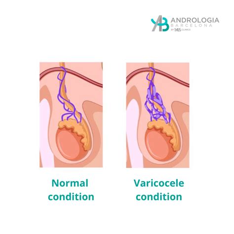 Varicocele Versus Normal
