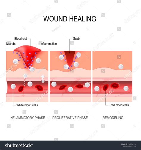 Granulation Tissue Wound