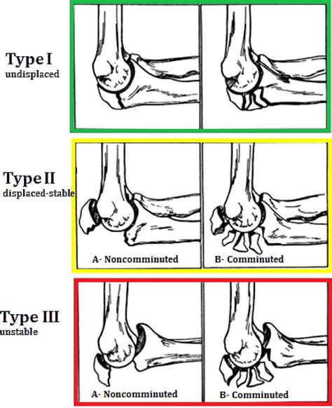 Olecranon fracture causes, symptoms, diagnosis, treatment & prognosis