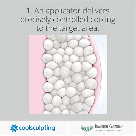 CoolSculpting® Vancouver w/ Cost Info | Fat Freezing in Surrey | BC Laser