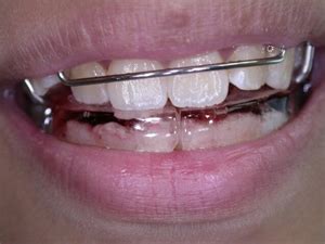 Image result for Retainer Problems