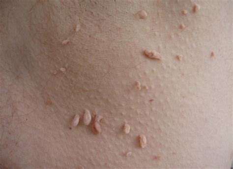 What Causes Skin Tags? | Healthcare-Online