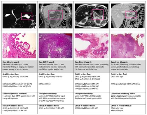 Differentiating Main-Duct IPMN from Chronic Pancreatitis Using Next ...