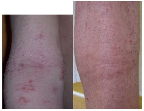 JAK-STAT Inhibitors in Atopic Dermatitis from Pathogenesis to Clinical ...