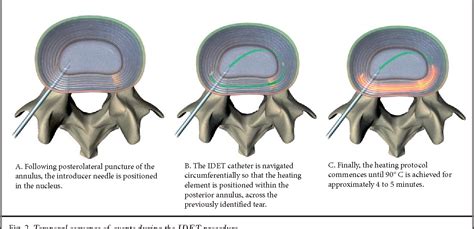 Image result for Idet Disc Procedure