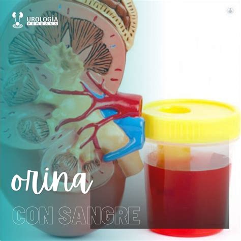 Sangre en la orina – Urología Peruana. Dr. Susaníbar