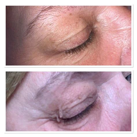 Skin Tag Removal - Fareham - Dermatouch Skin Clinic