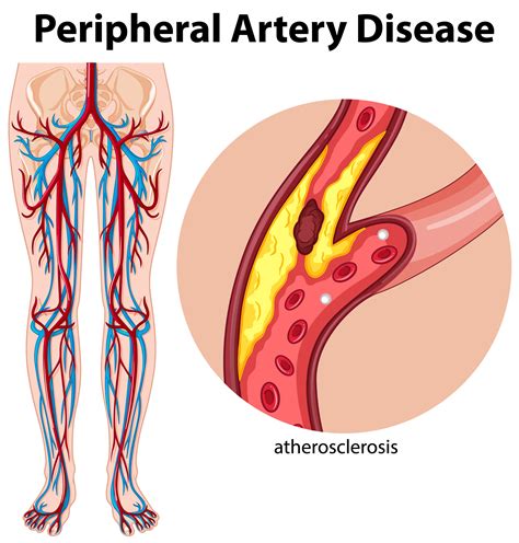 Why Exercise is Essential for Peripheral Artery Disease Patients