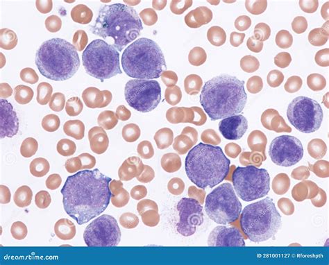 Leucemia mieloide aguda. imagen de archivo. Imagen de microscopio ...