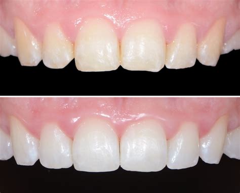 Brisbane Composite Bonding | le tooth