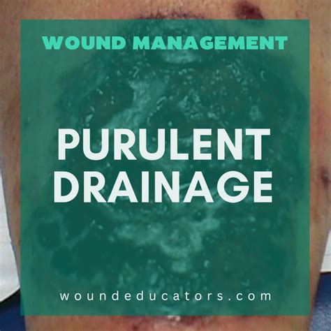 Purulent Drainage Pus Proficiency: Understanding Purulent Drainage