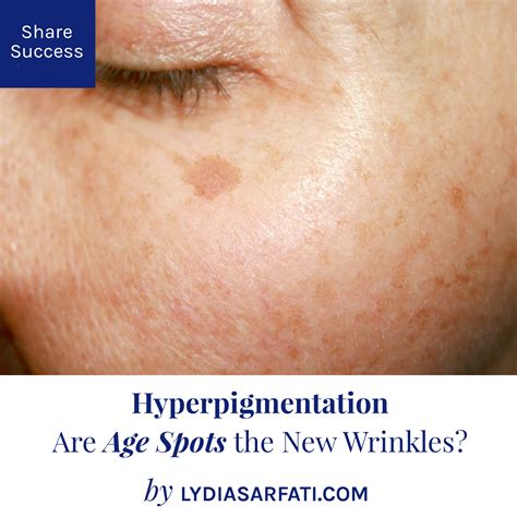Spots On Skin Skin Lesions: Pictures, Types, Causes, Treatment