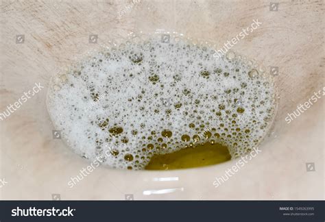 33 Foamy Urine Images, Stock Photos & Vectors | Shutterstock