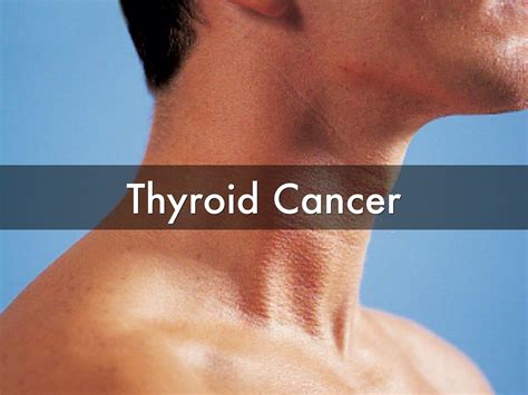 Thyroid Cancer - Types - Signs, Symptoms, Stages & Treatment