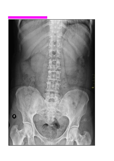 Crianca De Raio X Abdominal Normal Residência Pediátrica Uma