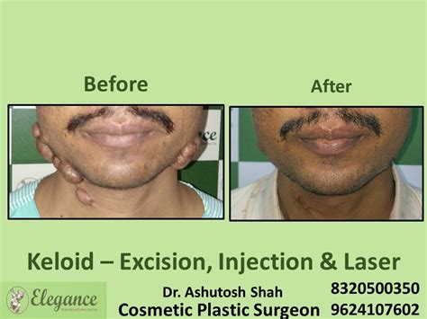 Keloid Excision, Injection and Laser Treatment in Vesu, Udhna, Surat