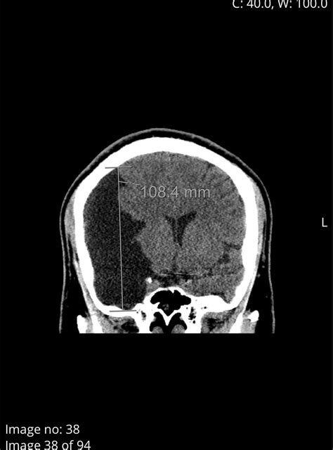 Incidental finding - Arachnoid cyst in brain : r/Radiology