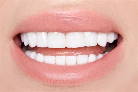 The Complete Guide to Getting Veneers [Updated for 2020]