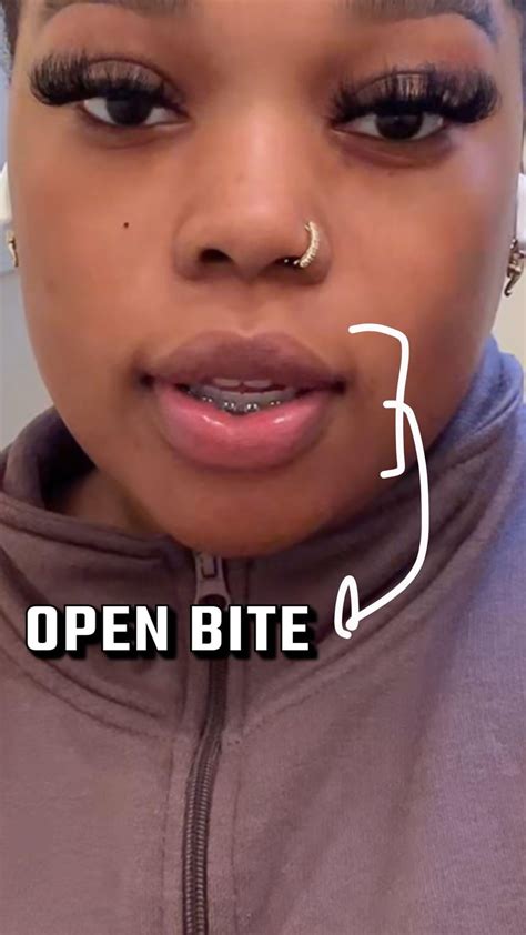 Jaw surgery ruined my face (before/after) : r/jawsurgery