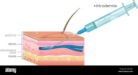 Injection Needle Drawing 的图像结果