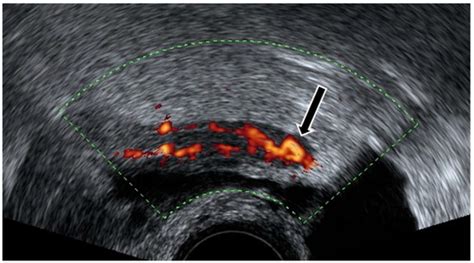 Extra-Gynecological Pelvic Pathology: A Challenge in the Differential ...