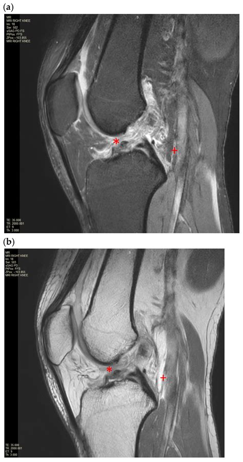 Anterior Cruciate Ligament Rupture with Concurrent Gastrocnemius Tear ...