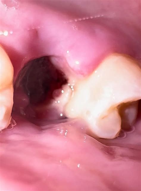 Tooth Socket After Extraction 的图像结果