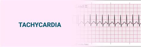 Taquicardia: tipos, síntomas, causas y prevención efectiva