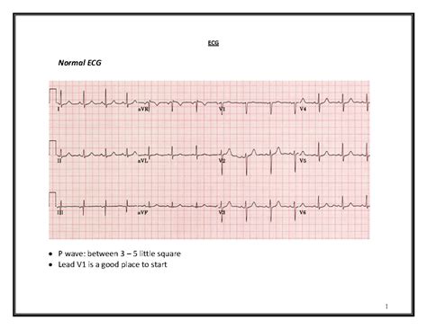 ECG Analysis: Normal Sinus Rhythm & Arrhythmias Overview - Studocu